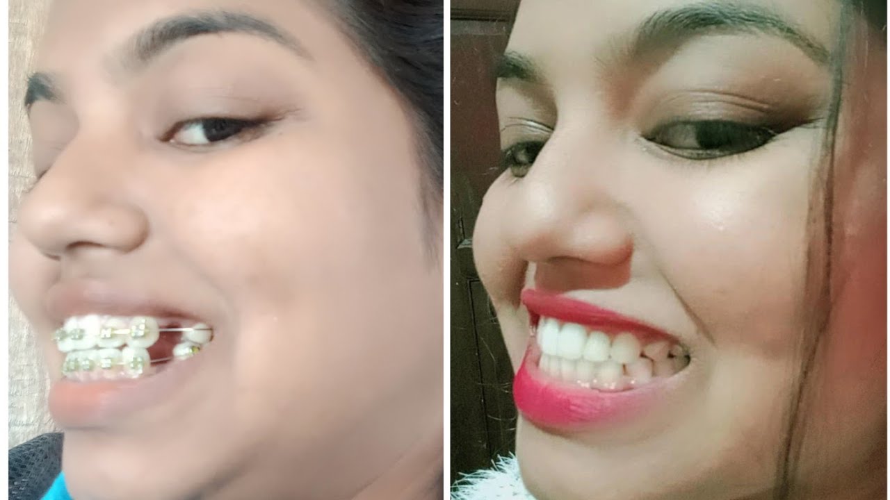 MY BRACES JOURNEY MONTHS / Braces Journey transformation YouTube