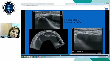 ¿Los implantes mamarios pueden provocar un linfoma?