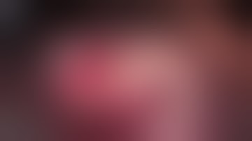 Lateral Ridge Augmentation #4-5 Sites, Mineross & Memlok, Release, Membrane App & Bone Fill