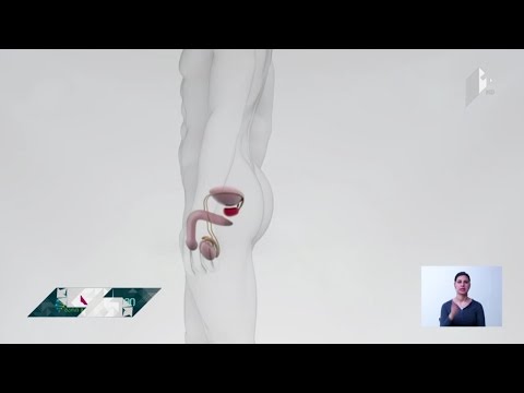 პროსტატის კიბოს ლოკალური მკურნალობა უახლოეს მომავალში შესაძლებელი იქნება