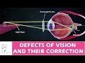 The defects of vision