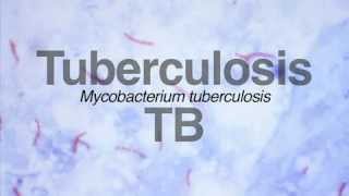 Screening of Latent TB Infection (LTBI)