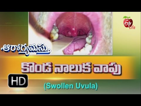 Aarogyamastu | Swollen Uvula | 6th January 2017 | ఆరోగ్యమస్తు