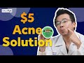 $5 Acne Treatment | Cheapest Way To Get Rid Of Acne