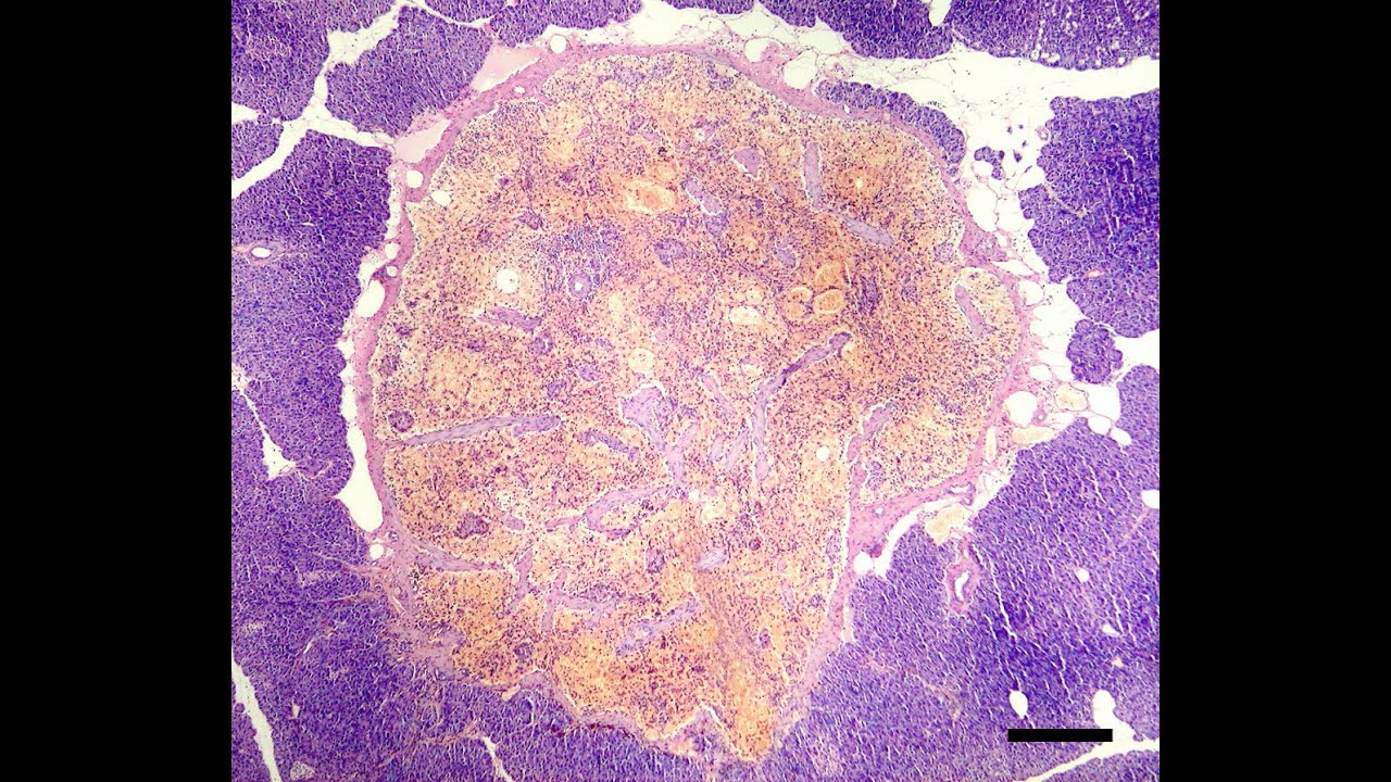 Ткань селезенки. Поджелудочная железа гистология. Селезенка микропрепарат гистология. Селезенка гистология препарат. Карцинома поджелудочной железы гистология.