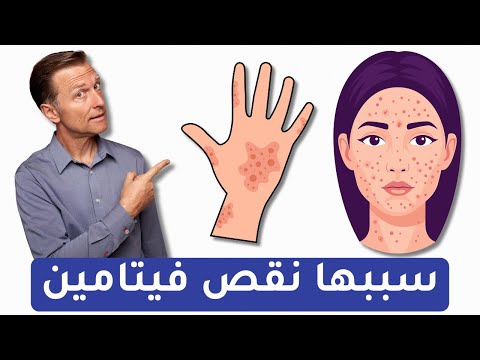 نقص هذا الفيتامين وراء مشاكل جلدية كثيرة