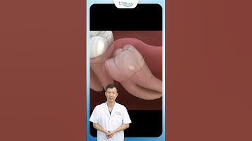 Răng 8 Mọc Lệch | Bác Sĩ Yên