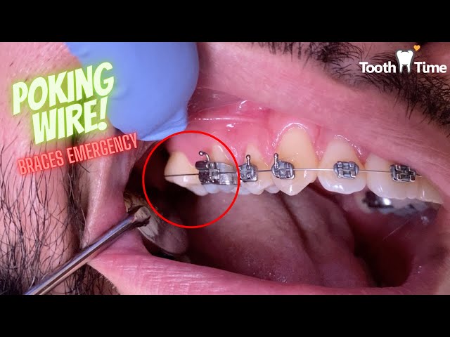 Braces Emergency - What to do if you have a Poking Wire - Tooth Time Family  Dentistry New Braunfels 