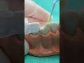 Resina dental con guía de silicona