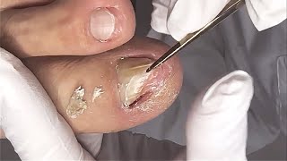 Stabbing into the flesh! Removal of deep ingrown toenail
