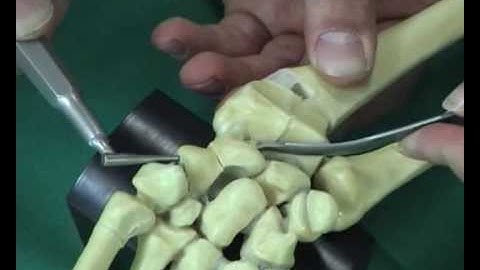 HBS (Headless bone screw) – Part 1