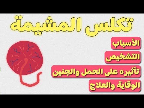 تكلس المشيمة كل ما يجب أن تعرفه الحامل