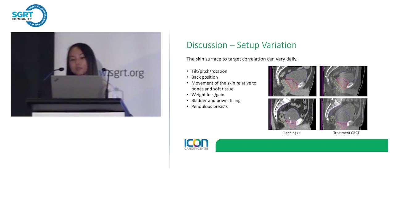 An Initial Clinical Experience with Surface Guided Radiation Therapy