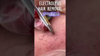 Electrolysis Hair Removal