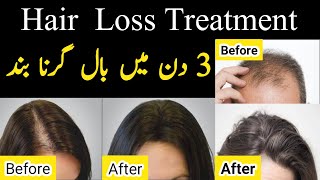 Hair Loss Treatment for Men & Women | Hair Loss Home Remedies