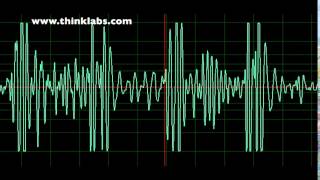 Atrial Septal Defect- normal speed Wealth