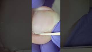 Feel relief pain from this ingrown toenail removal