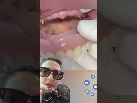 وداعا عدم ثبات طقم الأسنان المتحرك