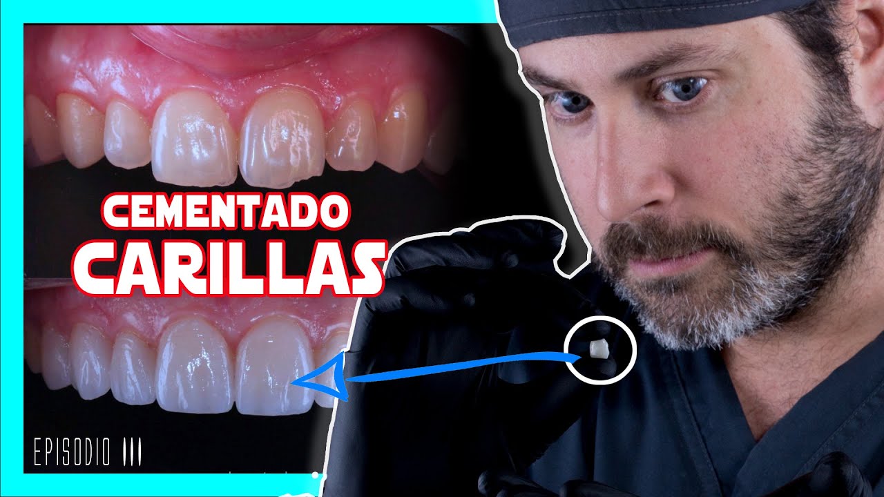 👉COMO se ponen las 𝘾𝘼𝙍𝙄𝙇𝙇𝘼𝙎 𝙙𝙚 𝙋𝙊𝙍𝘾𝙀𝙇𝘼𝙉𝘼 en los dientes  [Te lo explico FÁCIL , COMPRUEBALO✓] 