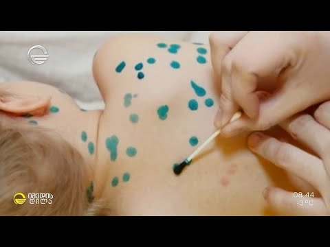 ჩუტყვავილა, წითელა, წითურა - სპეციფიკური გამონაყარით მიმდინარე სეზონური ინფექციური დაავადებები