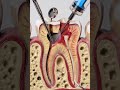 process of RCT # dental#b #biology #science