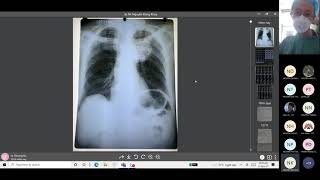 ĐỌC XQUANG NGỰC THẲNG TRONG HÔ HẤP | TS LÊ THƯỢNG VŨ