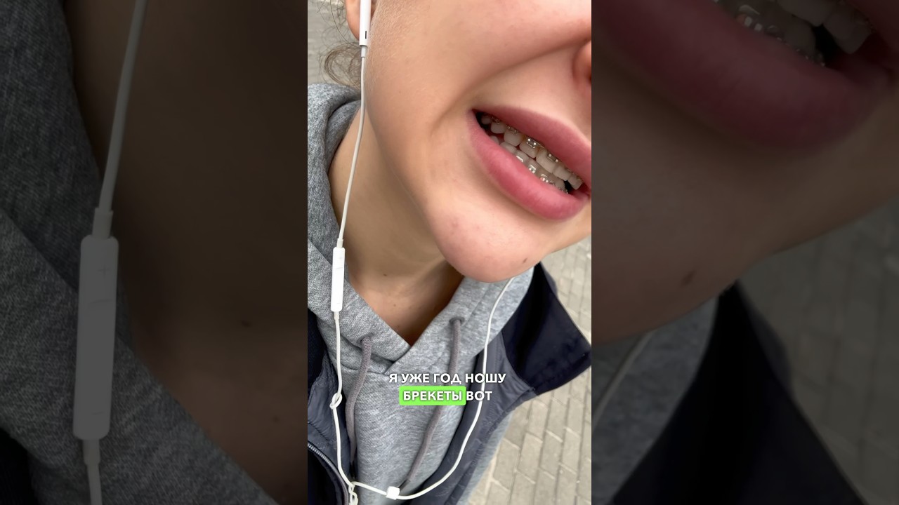 МИНУСЫ БРЕКЕТОВ🦷 #влоги #влоги