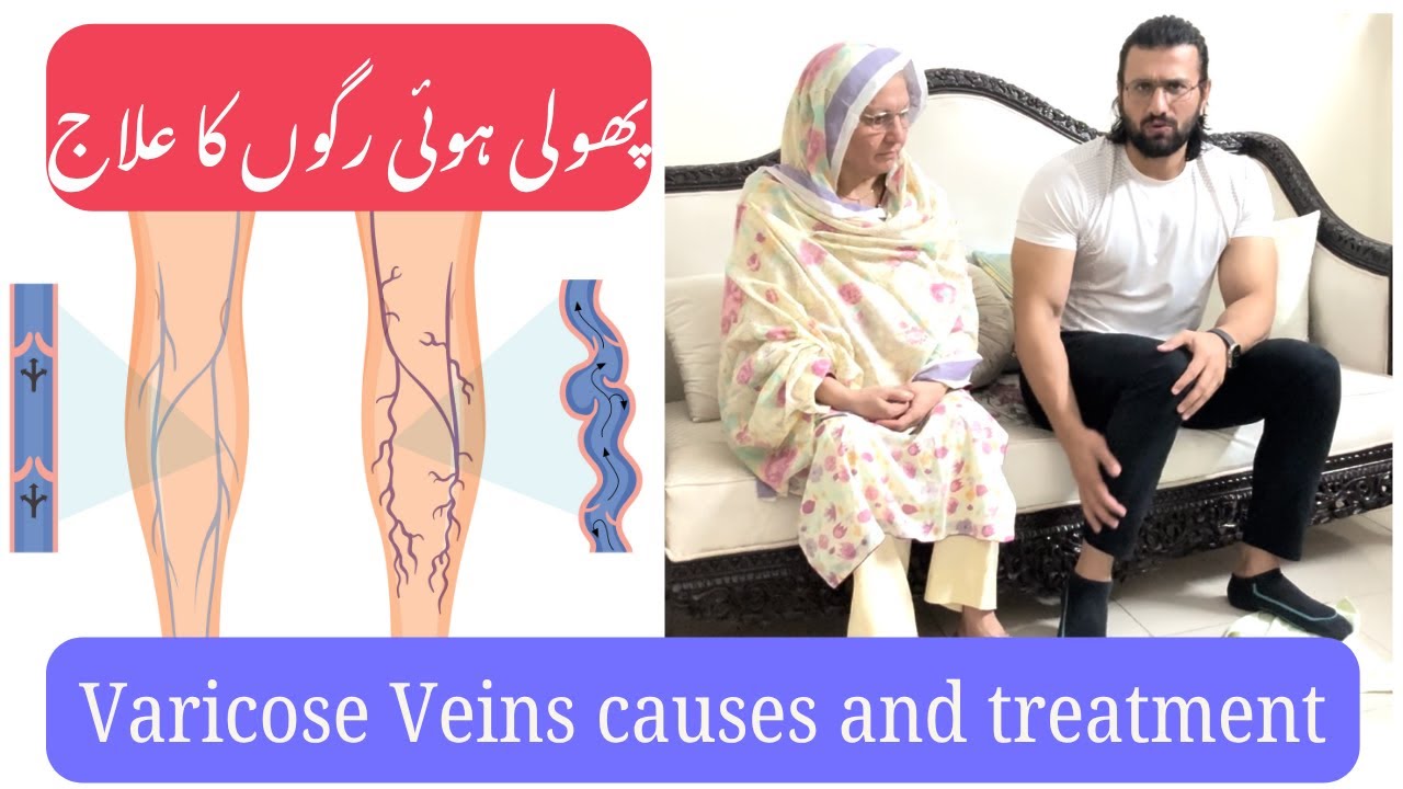 Senior Fitness Episode 21 | Varicose Veins Exercises