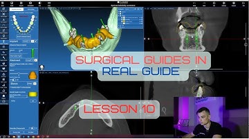 Surgical guides in RealGuide Tutorial. Lesson 10. All on 6 guide with one-stage teeth extraction