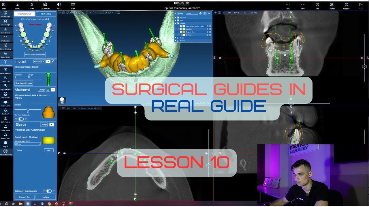 Surgical guides in RealGuide Tutorial. Lesson 10. All on 6 guide with ...