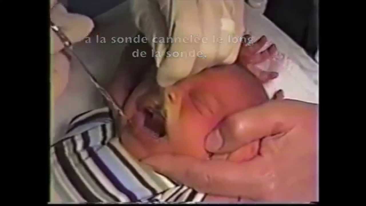 Frenotomie Nourrisson Demonstration Dr Ballard De Cincinatti Youtube