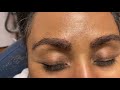 Dallas African-American Eyebrow & Hairline Transplant 2 Weeks Out