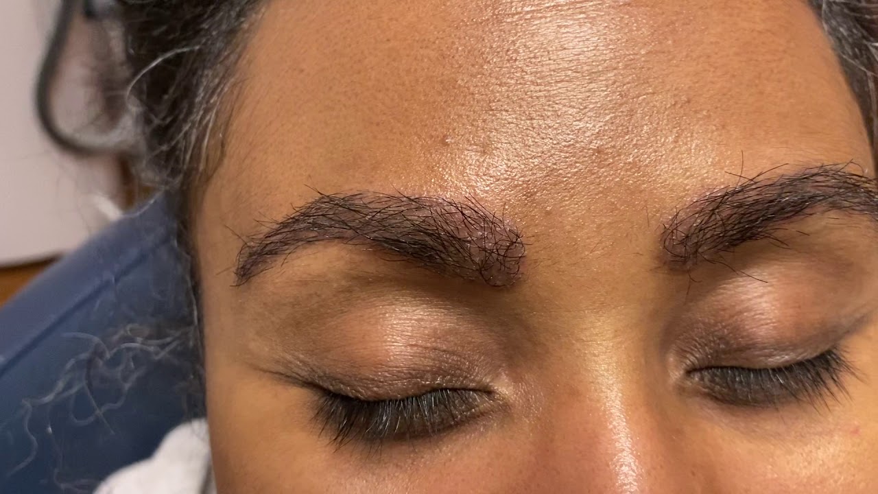 Dallas Eyebrow Hair Restoration Before and After Photos - Plano Plastic  Surgery Photo Gallery - Dr. Samuel LamFemale Eyebrow Hair Transplant  Archives | Lam, Sam ()