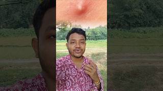 গরমে ব্রণের সমস্যায় নাজেহাল? #shorts #pimple #healthylifestyle #trending #bengali #fitness #health