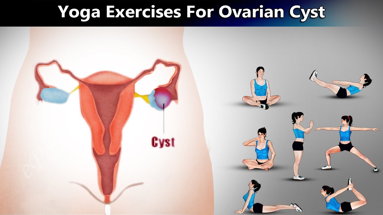 7 Yoga Poses for Ovarian Cyst YouTube