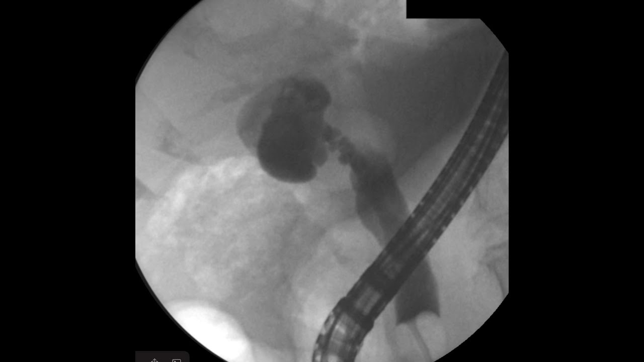 EUS guided GB drainage in nondistended gallbladder YouTube