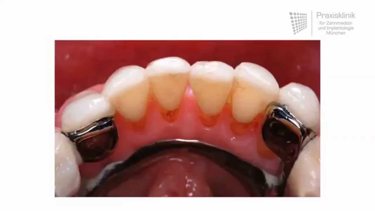 Oberkiefer teilprothese Herausnehmbarer Zahnersatz