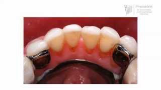 Zahnprothese oberkiefer mit gaumenplatte