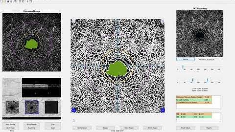 Quantitative Image Analysis for Retinal Optical Coherence Tomography  (OCTA) Angiography