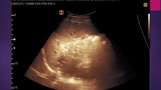 ultrasono case 5 Mild spleenomegally