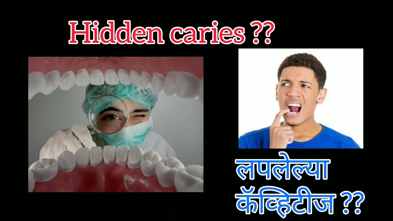 What is a hidden cavity?  लपलेली कीड म्हणजे काय?