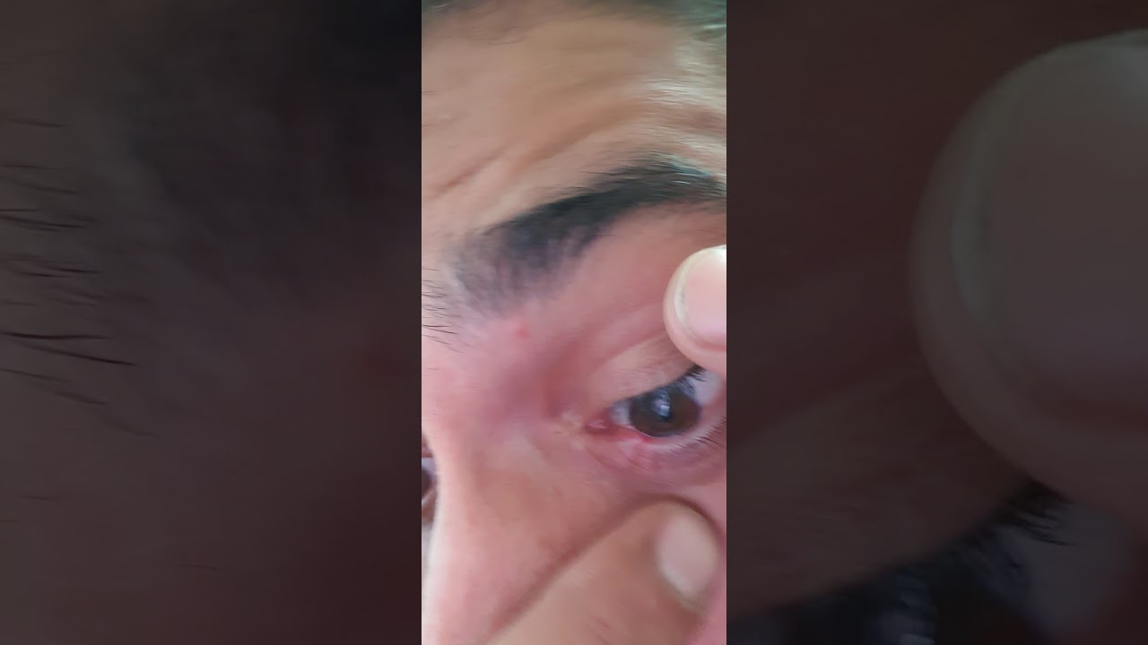 Espinha Dentro Do Olho O Que Fazer - NAZAEDU
