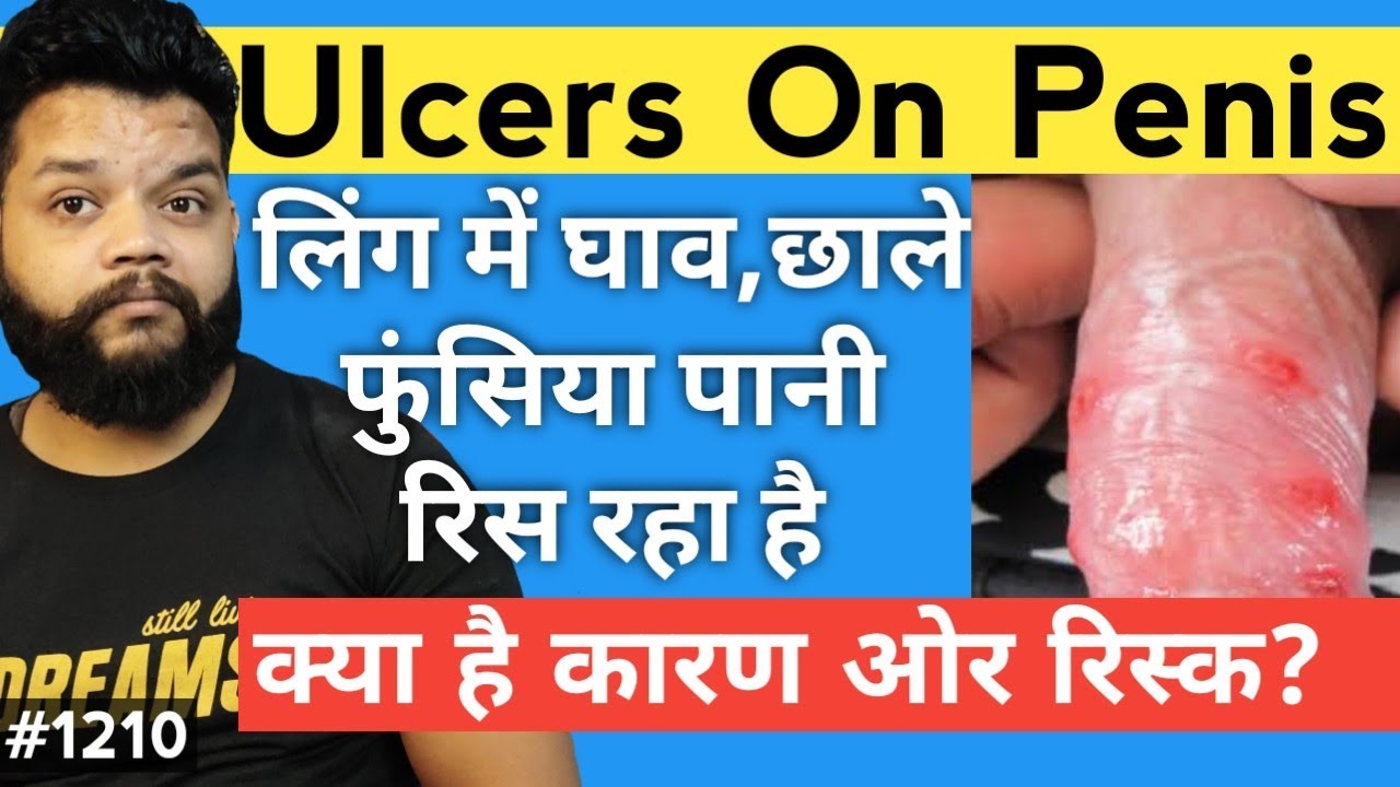 Penis Ulcer \u0026 Pimples Causes In Hindi | Genital Ulcer In Hindi