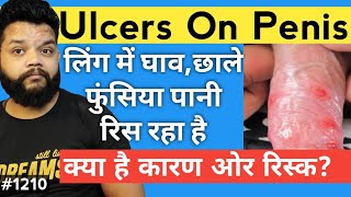 Penis Ulcer & Pimples Causes In Hindi | Genital Ulcer In Hindi screenshot 4