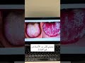 الطبقة البيضاء على اللسان فطريات ولا لسان مشعر