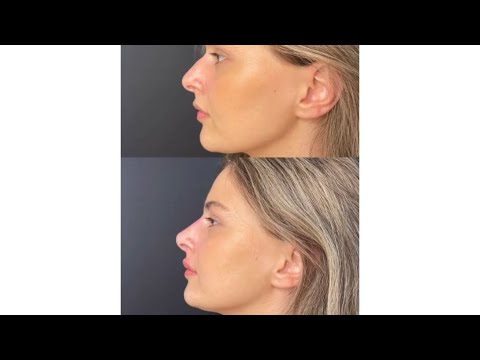 ჩემი ცხვირის before/after ფილერი ს შემდეგ