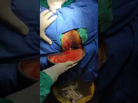 perianal abscess drainage