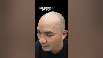 Đi chữa hói quá chán, hơn chục năm không mọc, cấy tóc thì không sống sợi nào #xămtóc #scalp