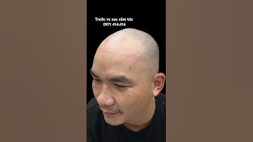 Đi chữa hói quá chán, hơn chục năm không mọc, cấy tóc thì không sống sợi nào #xămtóc #scalp