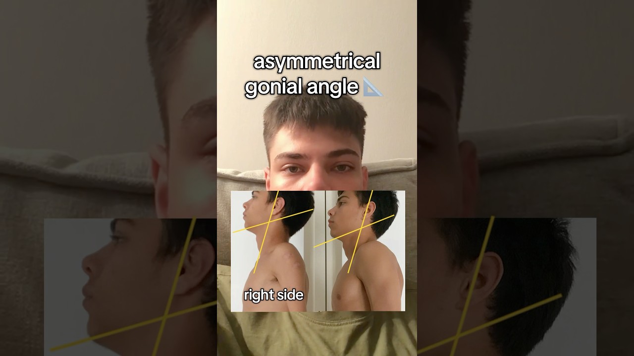 fix your gonial angle 